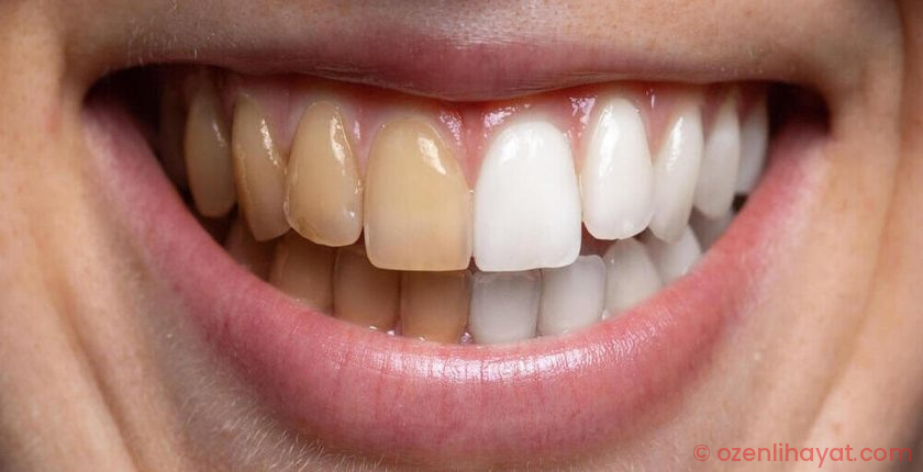 Bu gıdalar diş beyazlığını bozuyor!