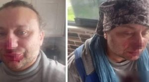 Ağır bakımdan çıkan Onur Akay pitbull dehşetini anlattı: ‘Ölümden döndüm’