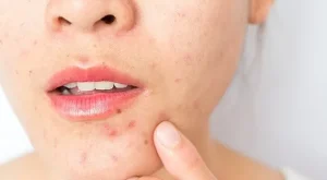 Cilt lekelerine karşı 5 kesin tahlil