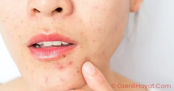 Cilt lekelerine karşı 5 kesin tahlil