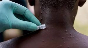 Dikkat edin yeni salgın kapıda! Maymun virüsü hakkında işte bilmeniz gerekenler.. Dikkat edin yeni salgın kapıda! Maymun virüsü hakkında işte bilmeniz gerekenler..