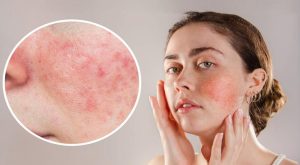 Gül hastalığı sandığınızdan daha yaygın: Gül hastalığının birinci belirtileri nelerdir?