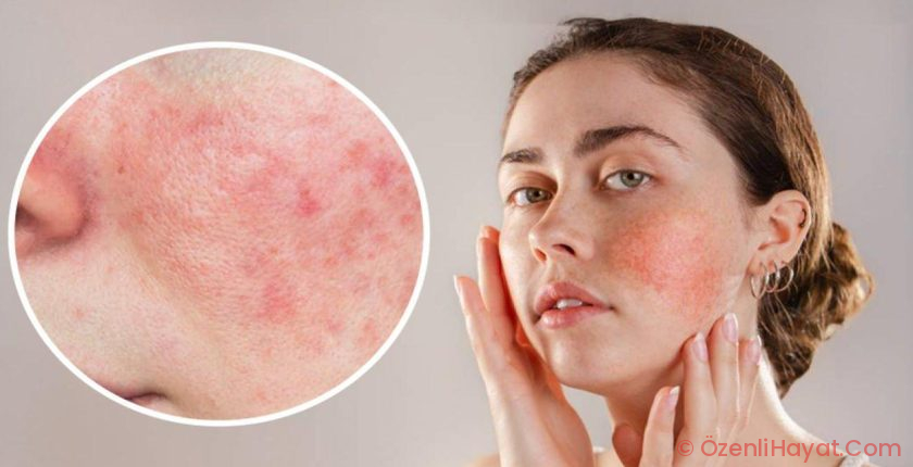 Gül hastalığı sandığınızdan daha yaygın: Gül hastalığının birinci belirtileri nelerdir?