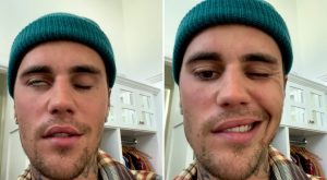 Justin Bieber, yüz felci hastalığıyla ilgili son durumunu paylaştı