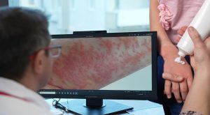 Uzman isim uyardı: Egzaması olan çocuklarda gereksiz diyet alerjiyi tetikleyebilir