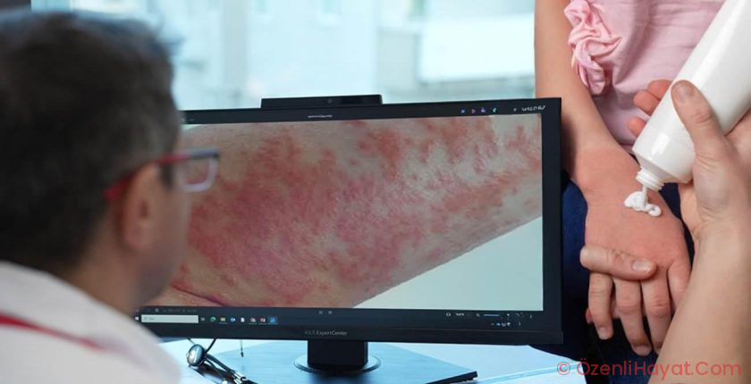 Uzman isim uyardı: Egzaması olan çocuklarda gereksiz diyet alerjiyi tetikleyebilir