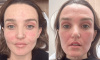 Everything to Know About Fraxel Laser, Chloe Fineman’s Go-To Skin Deva Treatment