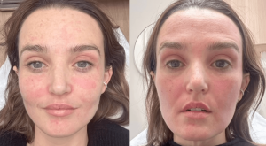 Everything to Know About Fraxel Laser, Chloe Fineman’s Go-To Skin Deva Treatment