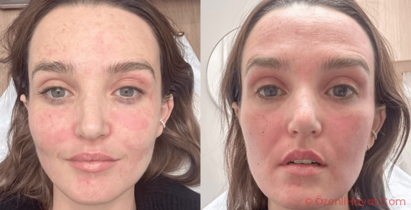 Everything to Know About Fraxel Laser, Chloe Fineman’s Go-To Skin Deva Treatment