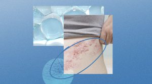 How to Prevent Long-Term Skin Damage from Shingles