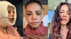 Yüz nakli geçiren Didem Ceran ateş püskürdü: ‘İnsanlar neden yaraya tuz basar?’