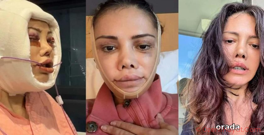 Yüz nakli geçiren Didem Ceran ateş püskürdü: ‘İnsanlar neden yaraya tuz basar?’