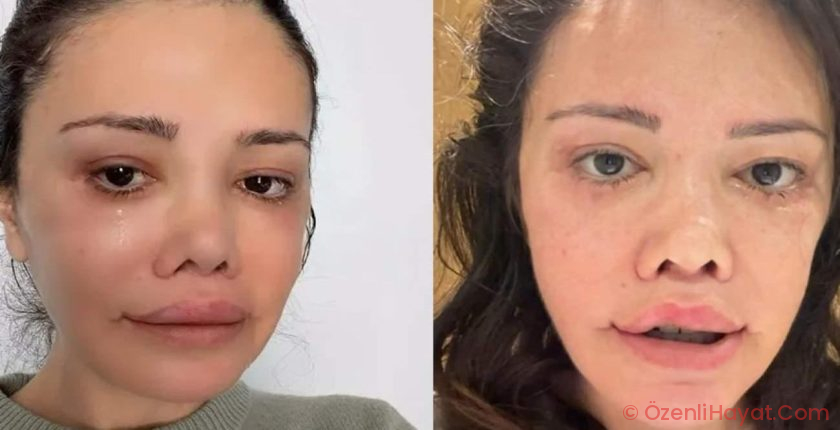 Yüz nakli olan Didem Ceran’ın gençlik sırrı yumurta çıktı! Yüz nakli olan Didem Ceran’ın gençlik sırrı yumurta çıktı!